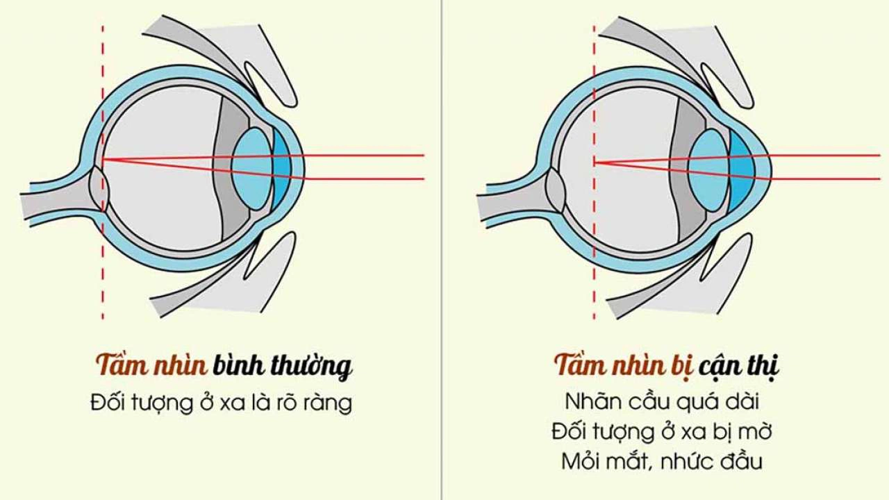 Cận thị một bên mắt: Nguyên nhân, dấu hiệu và điều trị