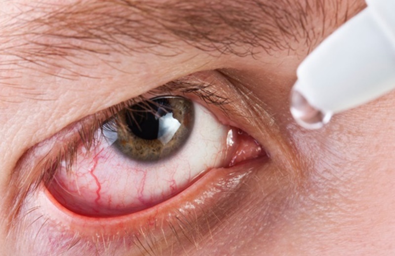 Đeo kính áp tròng thường xuyên có gây hại cho mắt không?
