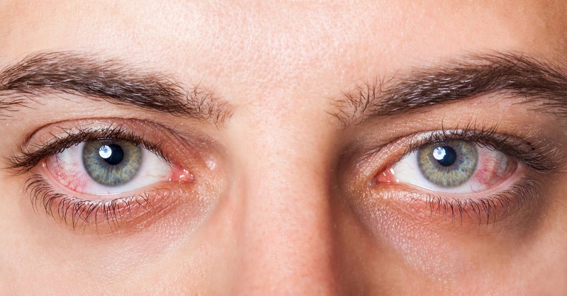 Phương pháp điều trị viêm kết mạc mắt (đau mắt đỏ) là gì?