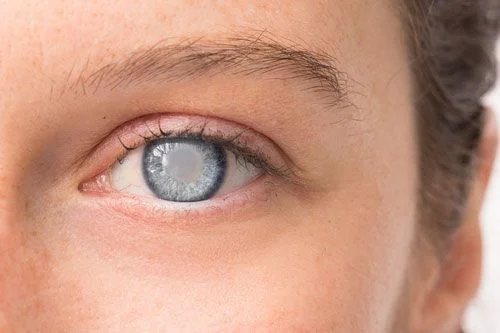10 Bệnh về mắt phổ biến thường gặp nhất